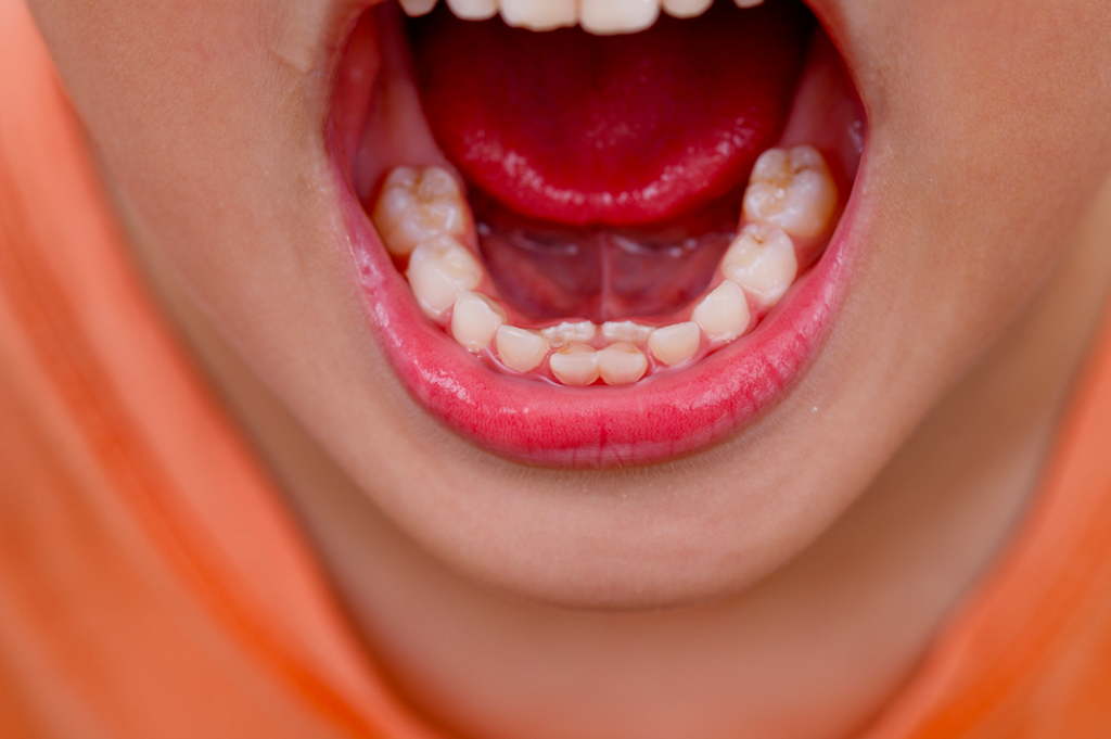 When Do Kids Get Their Permanent Teeth Learn More