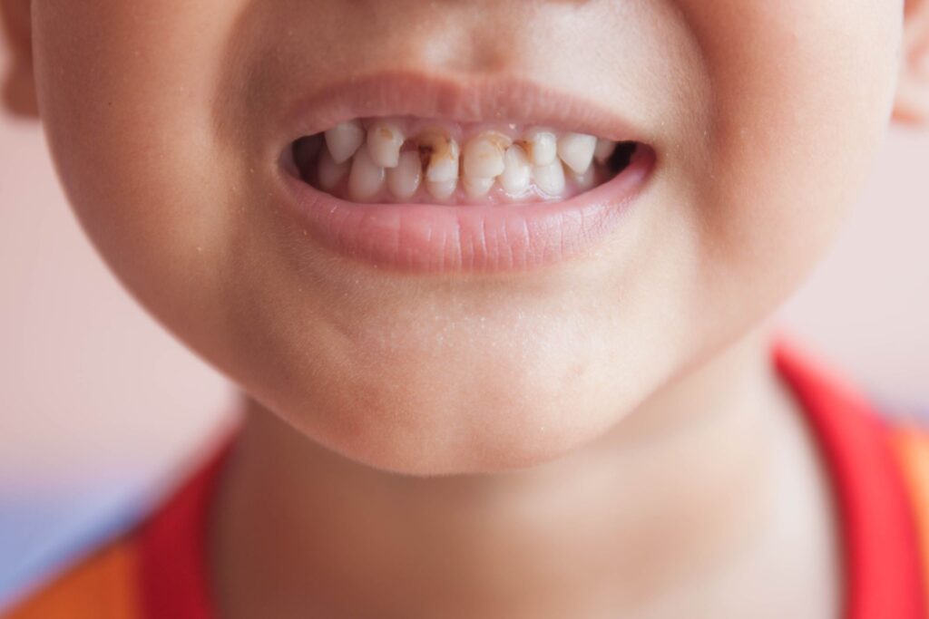 cavities in baby teeth