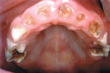 cavities in baby teeth