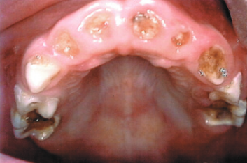 severe molar decay