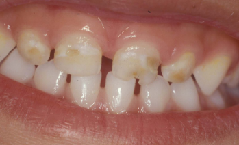 decalcification in baby teeth