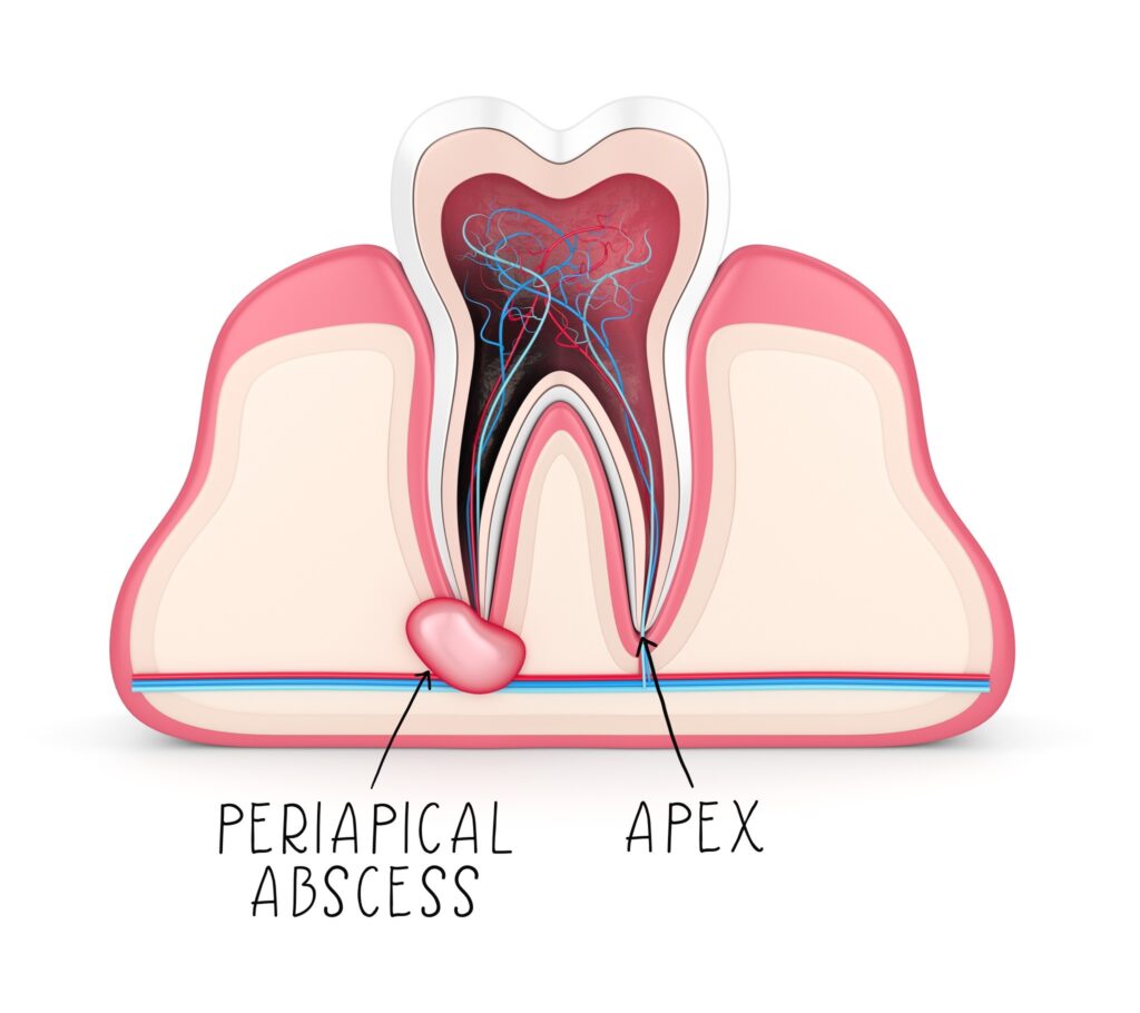 A periapical abscess is an abscess that forms around the tip of a tooth’s roots.