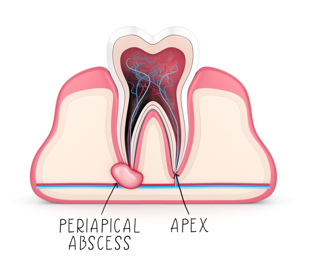 buccal space abscess