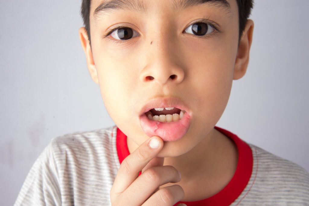 Child pointing at canker sore on lip