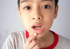 Child pointing at canker sore on lip